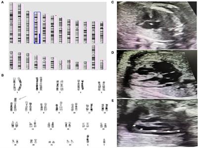 The Genetic Etiology Diagnosis of Fetal Growth Restriction Using Single-Nucleotide Polymorphism-Based Chromosomal Microarray Analysis